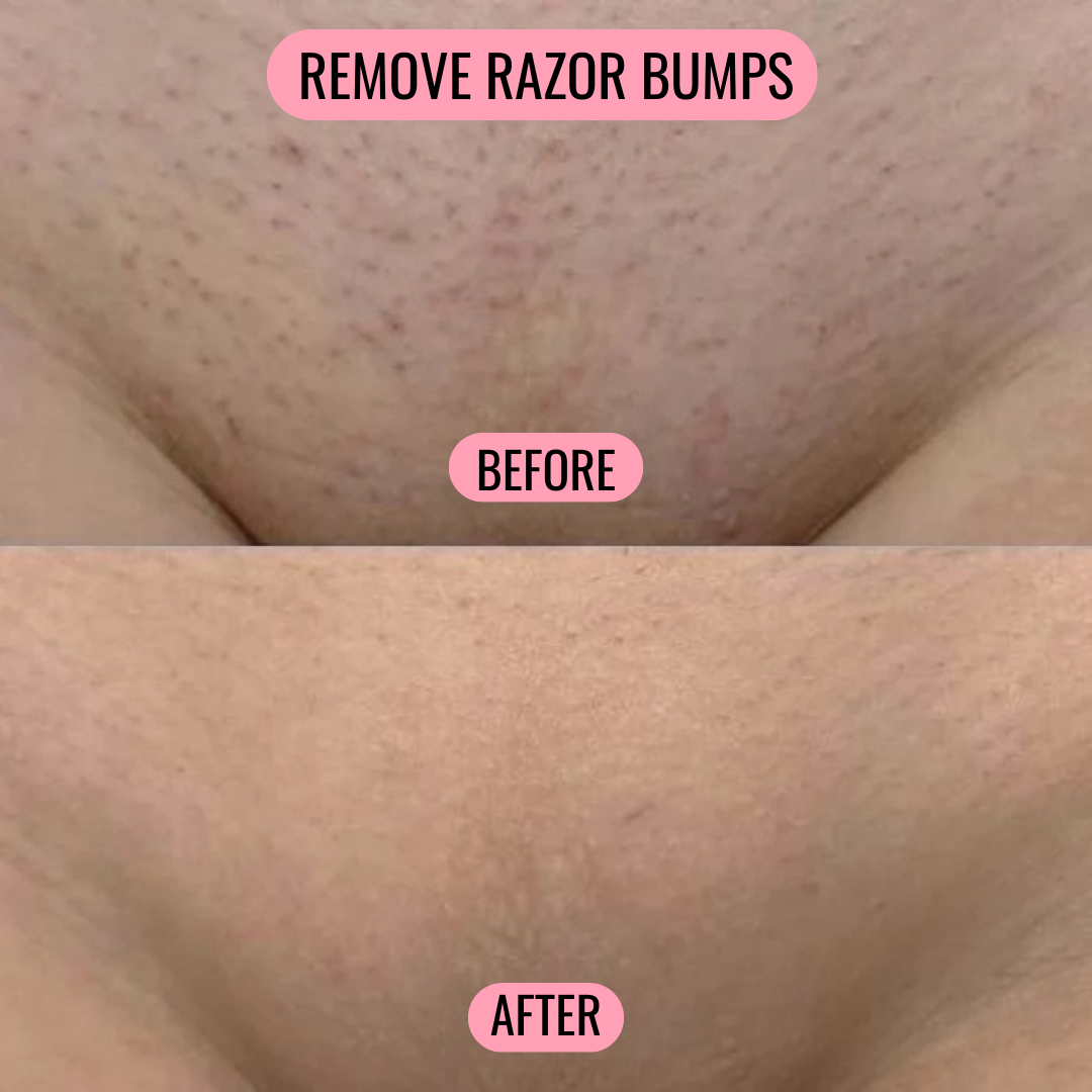 Femme Rejuv Oil For Bikini Line and Vulva